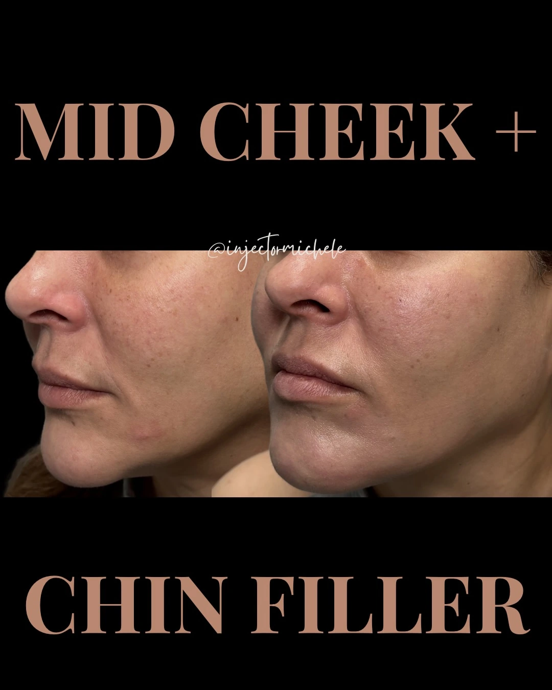 Original mid-cheek and chin filler comparison with both views and the treatment label preserved.