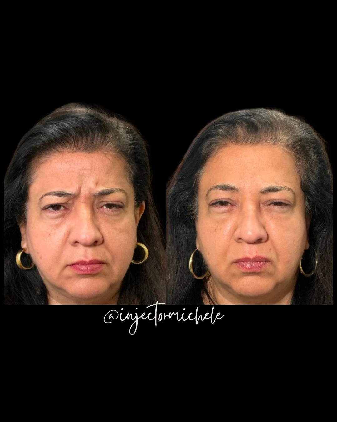 Original side-by-side Dysport comparison showing the area between the brows, with the source graphic intact.