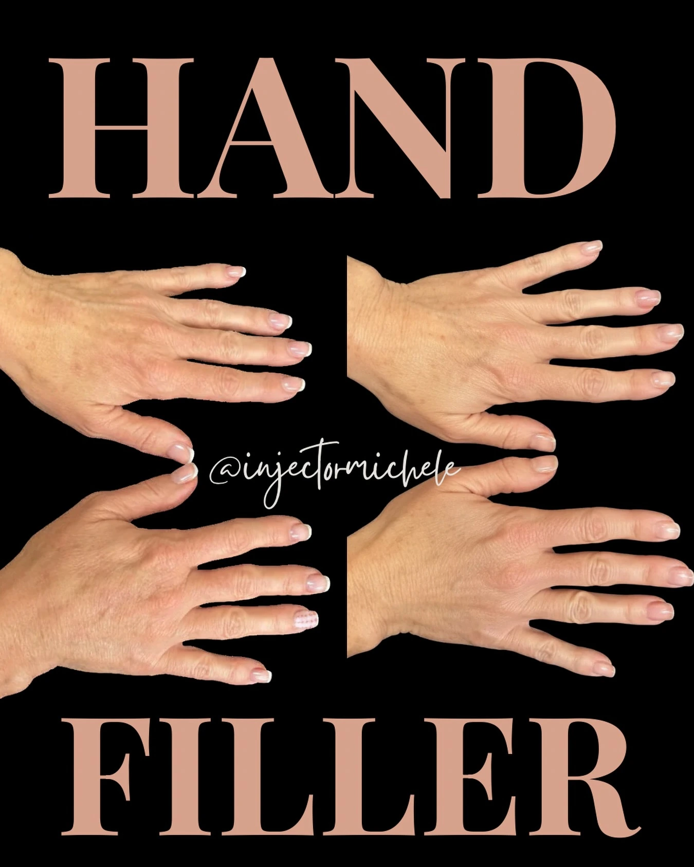 Original hand filler graphic showing the paired hand views together.