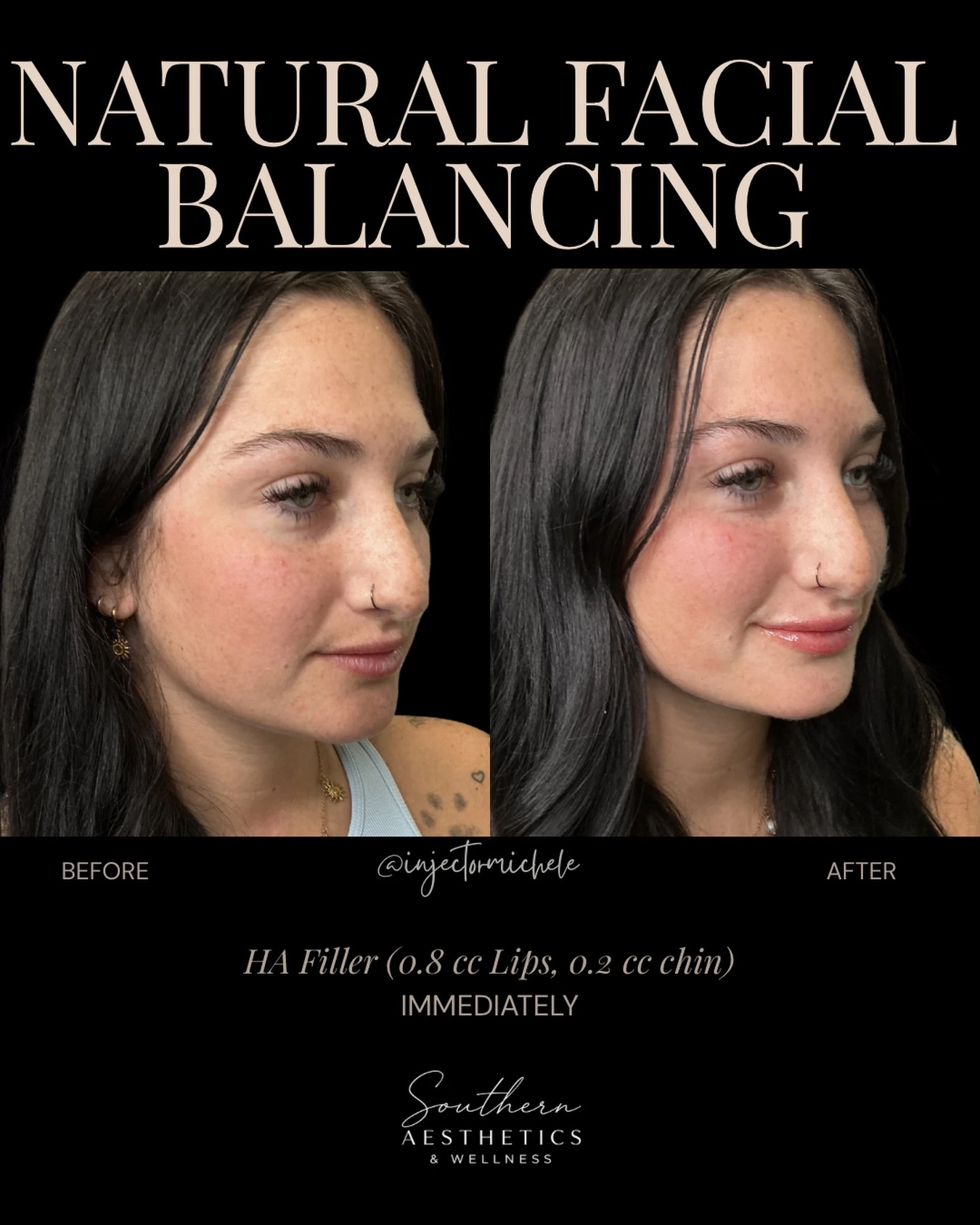 Original paired lip-and-chin filler photographs labelled before and immediately after, with the treatment areas and complete graphic preserved.