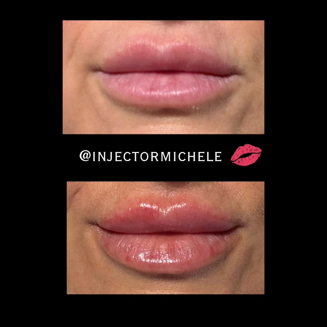 Original front-view lip comparison with both photographs and Michele's attribution intact.
