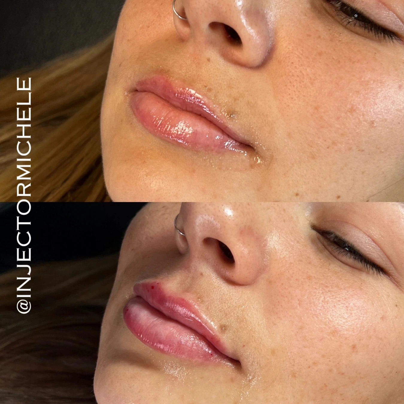 Michele's original paired angled lip photographs with the complete comparison and attribution preserved.