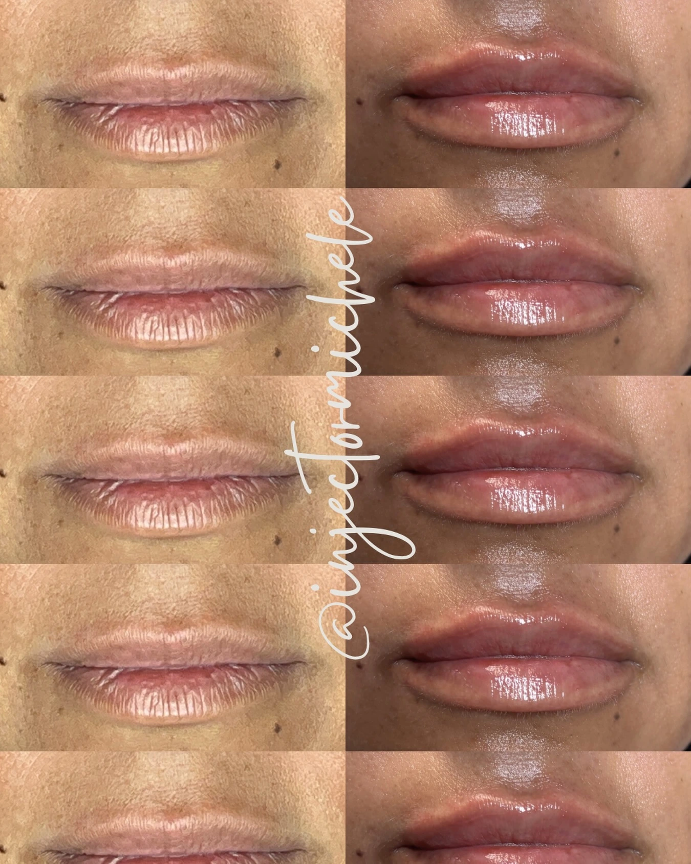 Original lip-filler comparison graphic repeating the same paired views in rows; this is one treatment example.