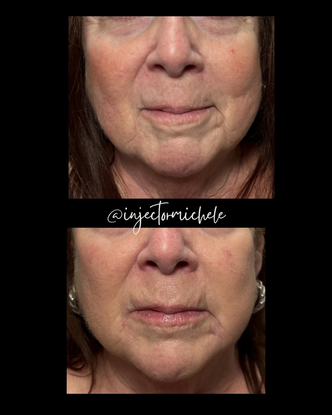 Original paired lower-face photographs from a filler and jawline Dysport treatment case.