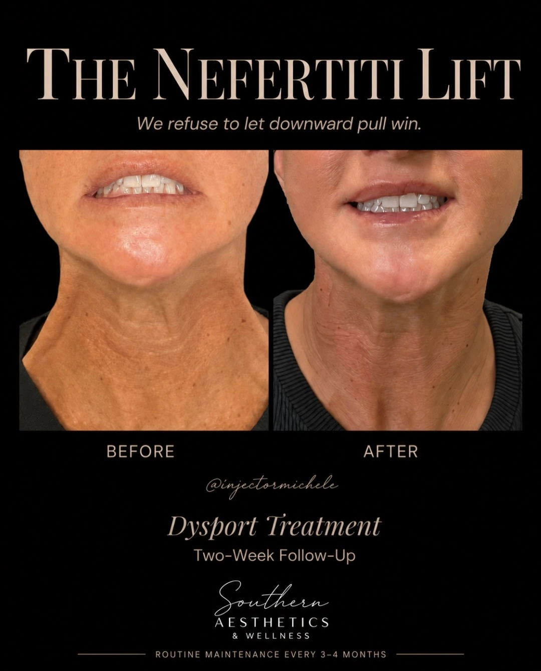 Original Nefertiti neck treatment before-and-after graphic, labelled Dysport and two-week follow-up.