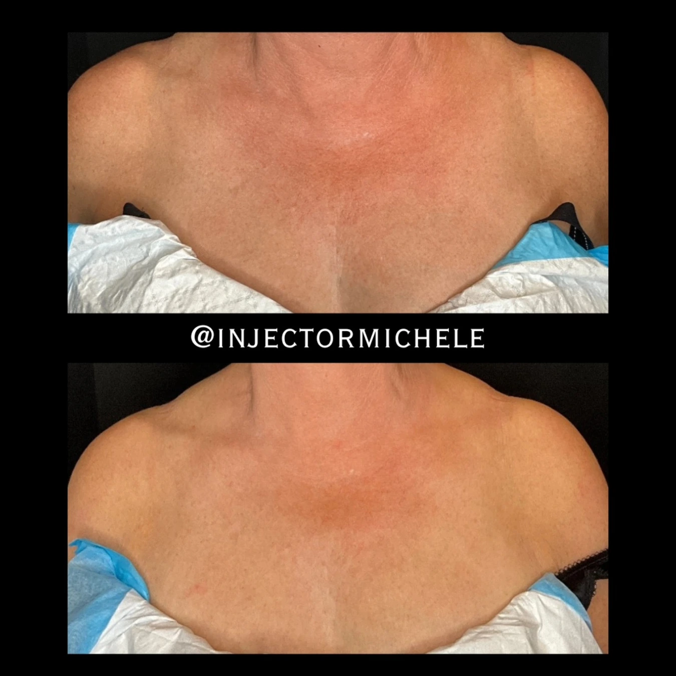 Michele's original paired chest photographs from a Sculptra case after two rounds of treatment.