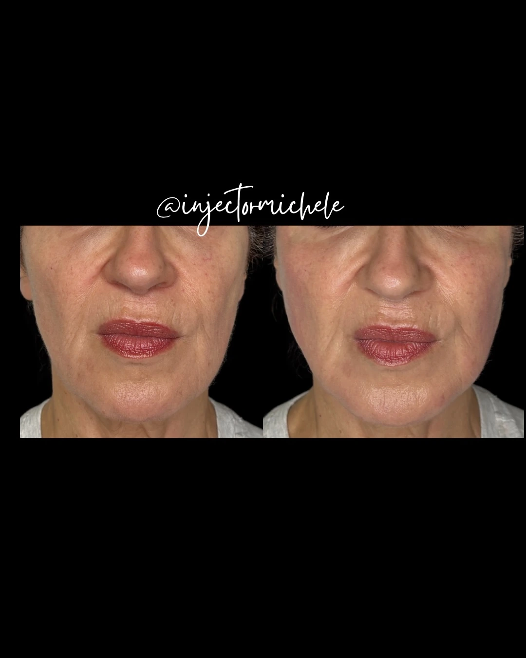 Original paired facial photographs showing before and immediately after Sculptra treatment.