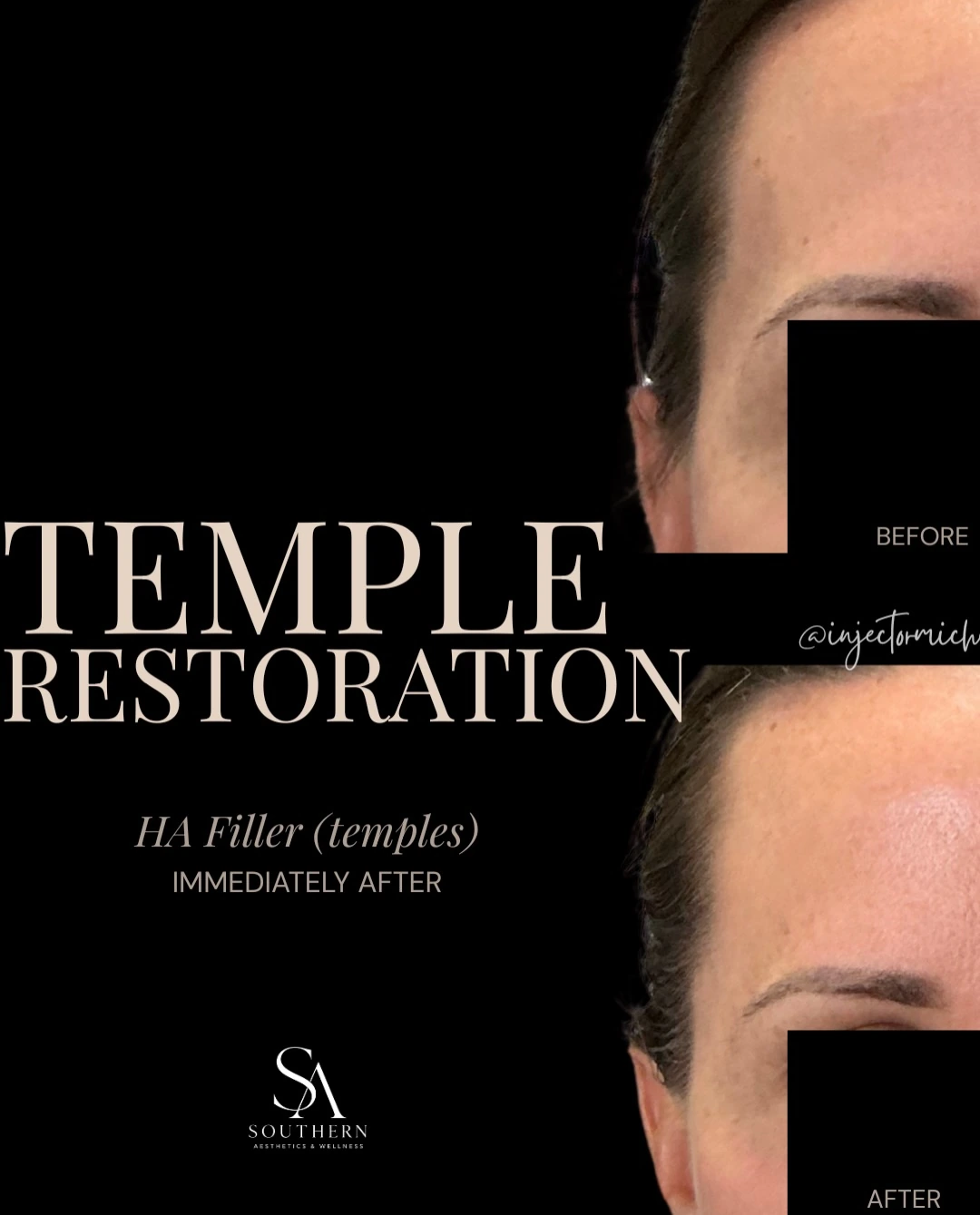 Original temple filler comparison with privacy masking, labelled before and immediately after treatment.