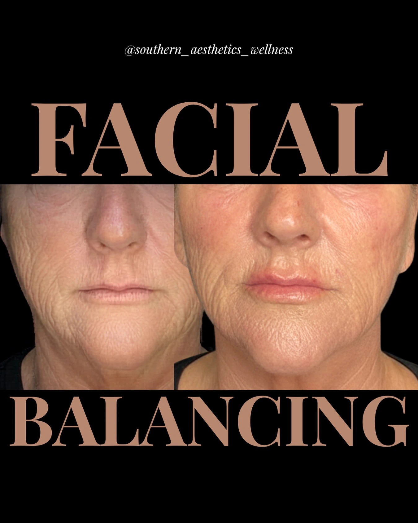 Michele's original paired facial-balancing photographs, with both comparison views and the original treatment label preserved.